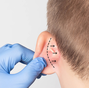 Ear Surgery (Otoplasty)