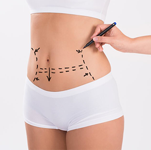 Tummy Tuck (Abdominoplasty)