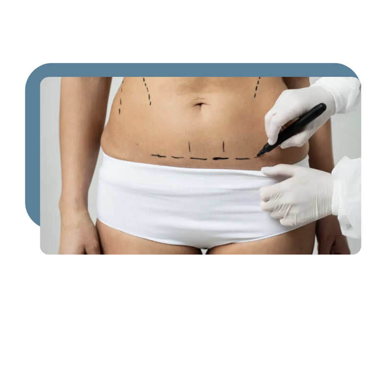 tummy tuck surgery